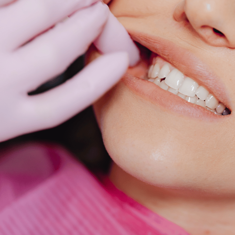 chipped tooth repair in villa rica ga